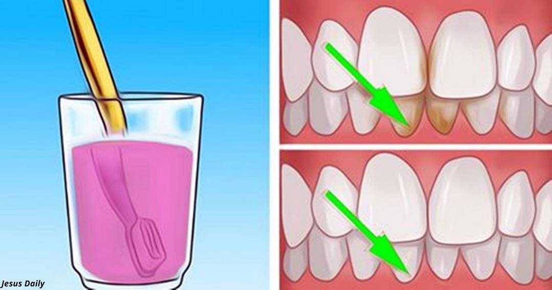 Вот как избавиться от зубного камня дома и без последствий