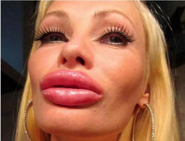 10 раз, когда кто-то сделал себе ″красивые губы″, хотя больше похоже на диагноз