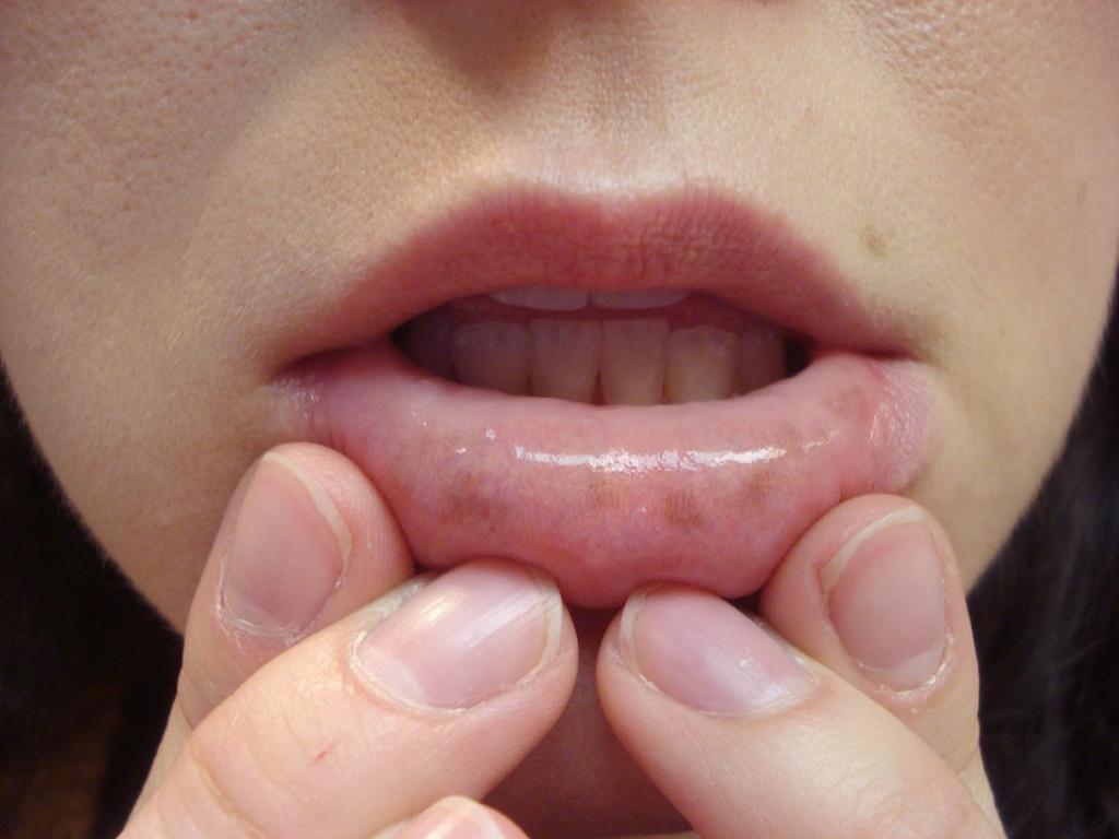 Трещины во рту - не самое страшное к чему приведет ношение маски - говорит врач