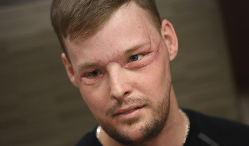 Невероятные результаты пересадки лица, сделанной парню после того, как он выстрелил себе в лицо