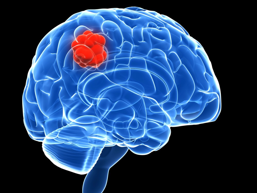 Что такое глиобластома головного мозга