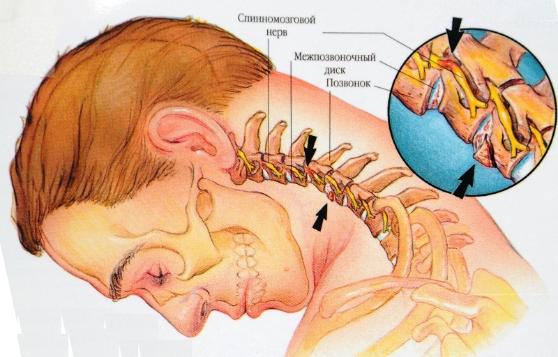 Напряженная шея: 3 техники для расслабления мышц 