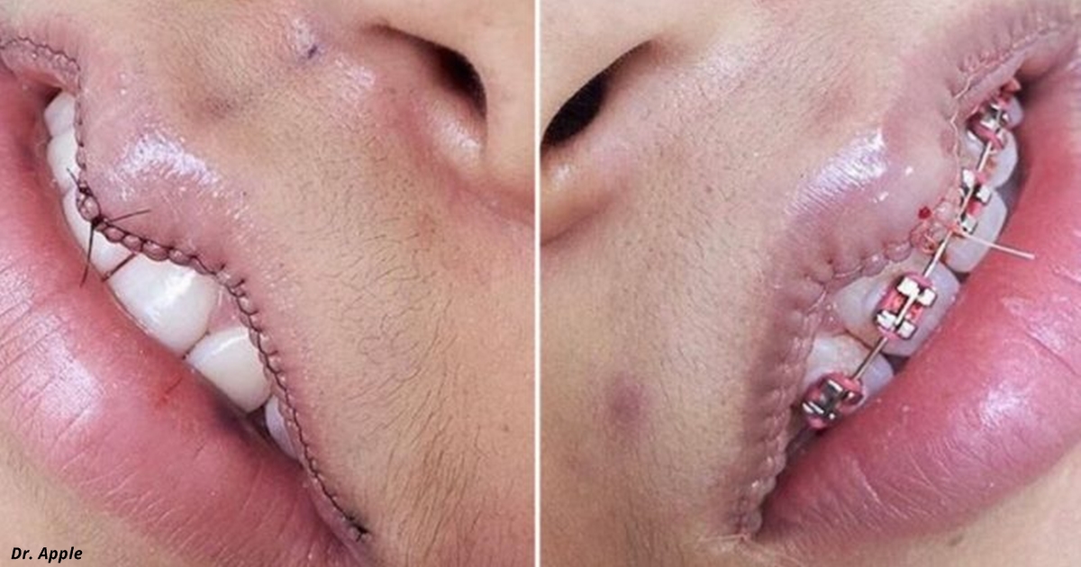 У гламурных девушек в Instagram новая фишка   операции по УМЕНЬШЕНИЮ губ! 