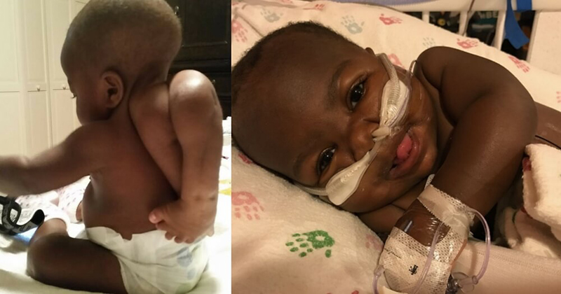 Эта девочка родилась с двумя лишними ногами на спине, но врачи сумели исправить ситуацию!